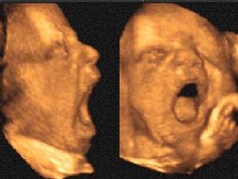 Un foetus en train de bailler.